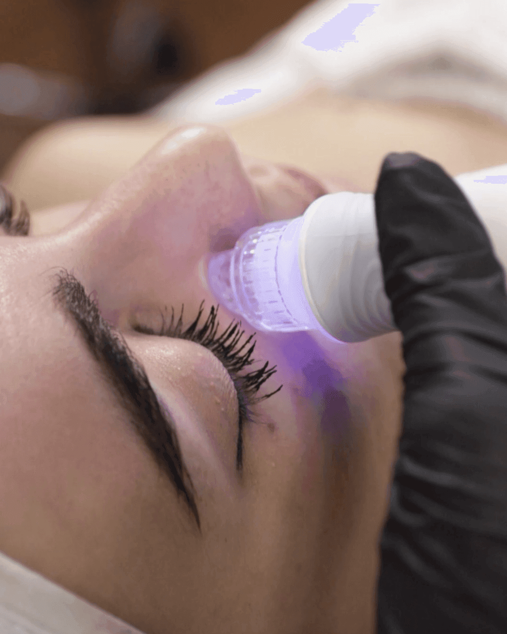 Manipolo di idrodermoabrasione di Hidraskin durante un trattamento viso